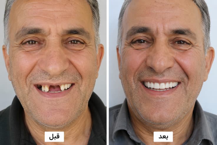 قبل و بعد ایمپلنت دندان- کلینیک دندانپزشکی بهخند